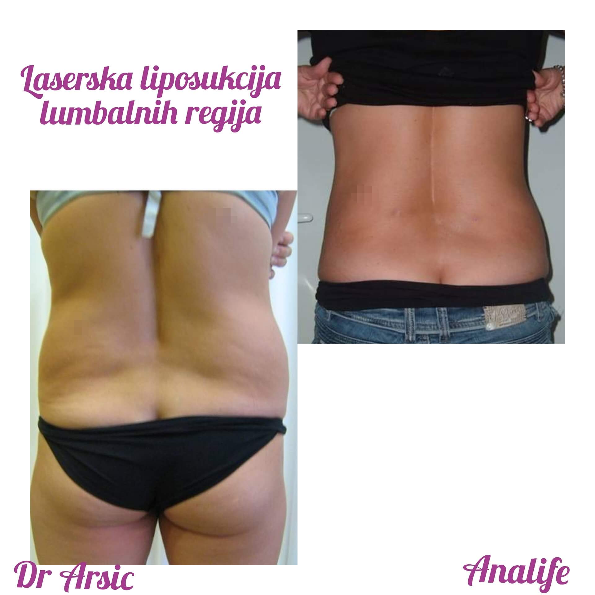 Laserska liposukcija stomaka, struka i leđa – oblikovanje linije tela - slika 8