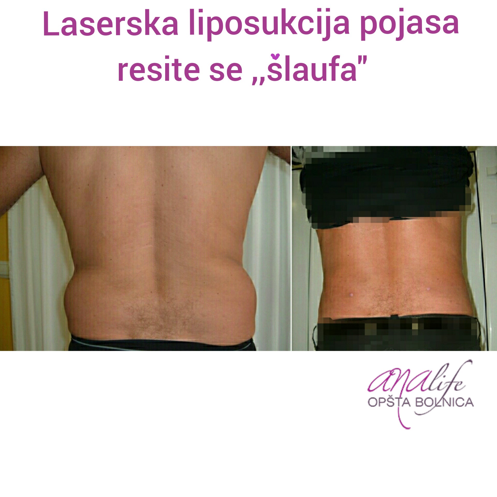 Laserska liposukcija stomaka, struka i leđa – oblikovanje linije tela - slika 9