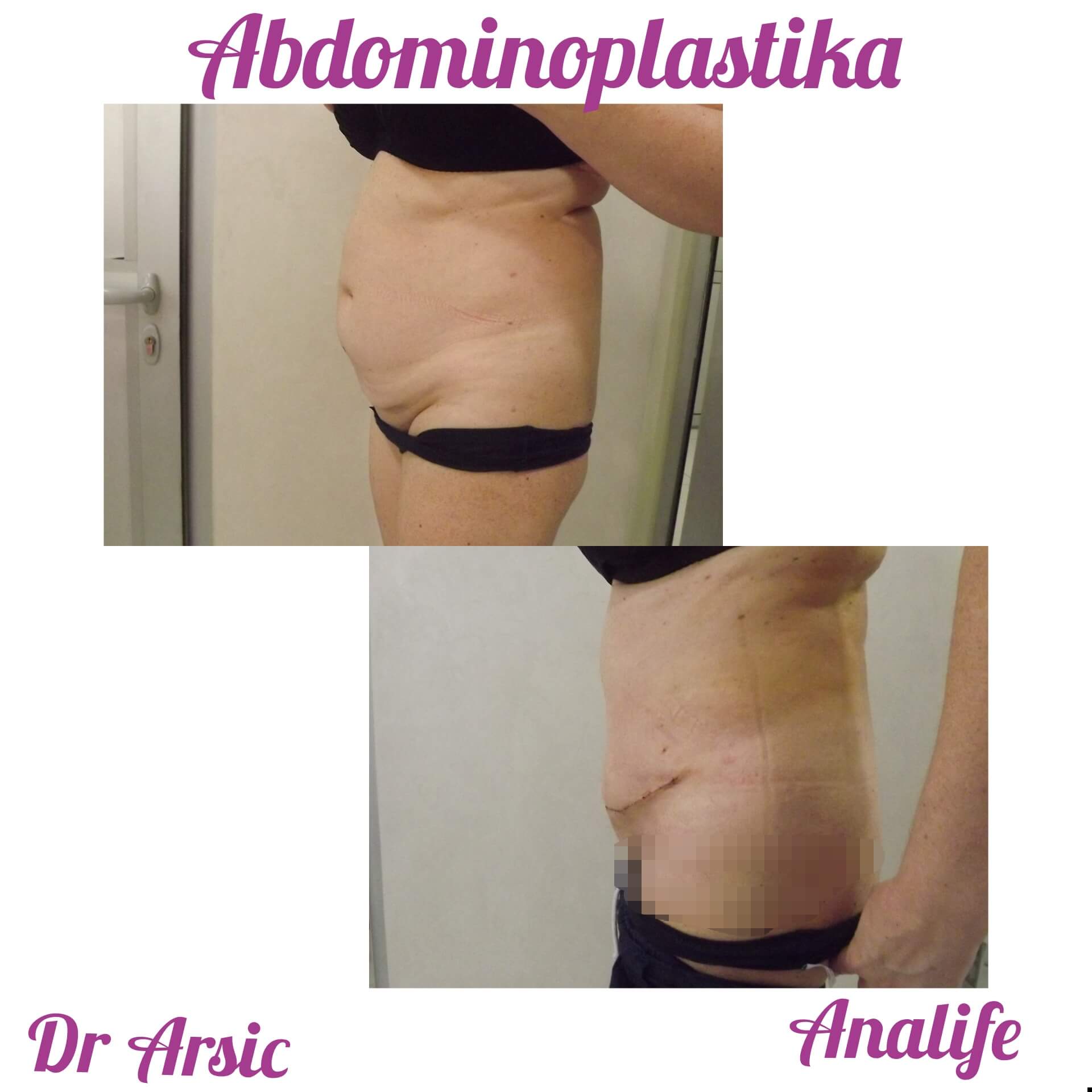 Laserska liposukcija stomaka, struka i leđa – oblikovanje linije tela - slika 10