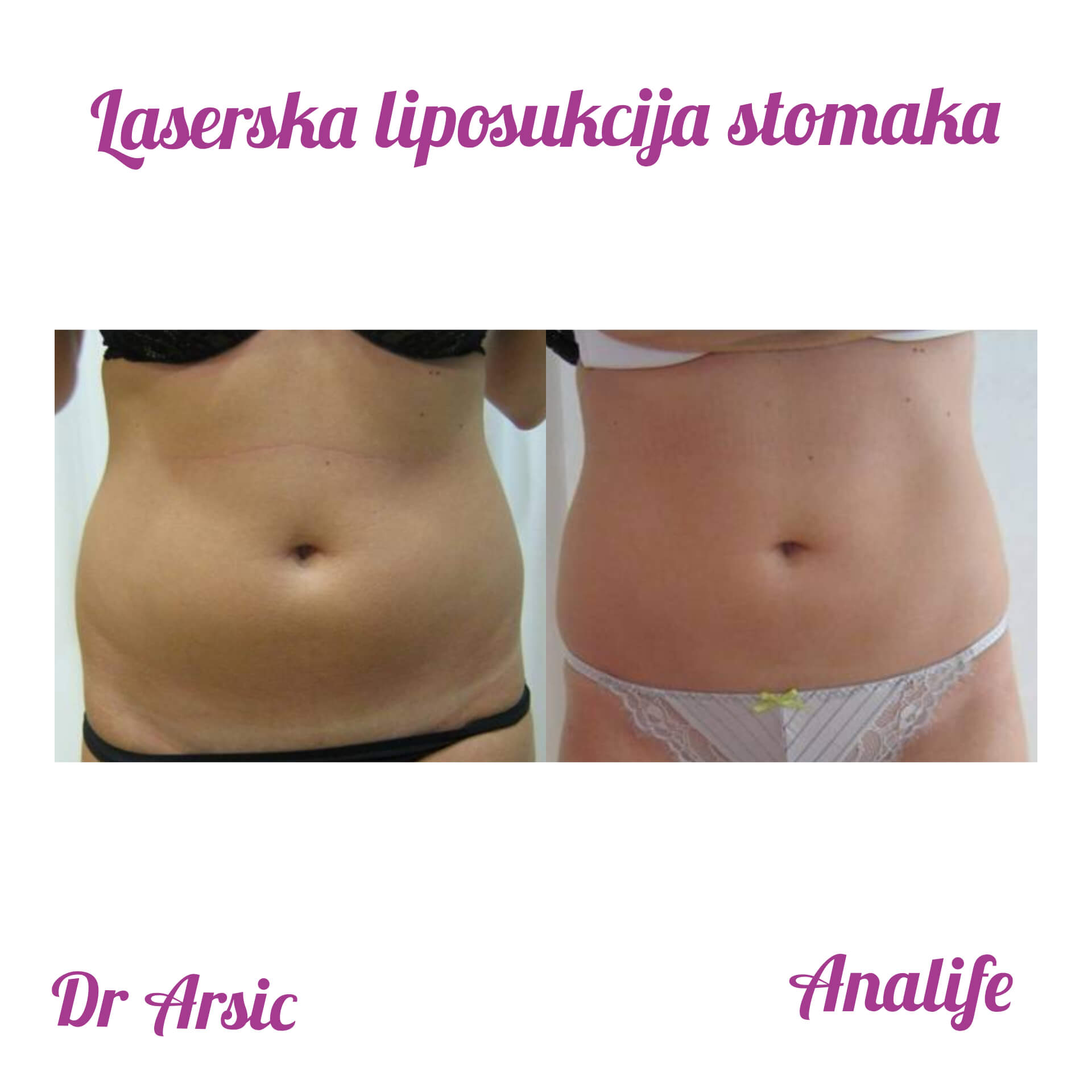 Laserska liposukcija stomaka, struka i leđa – oblikovanje linije tela - slika 11