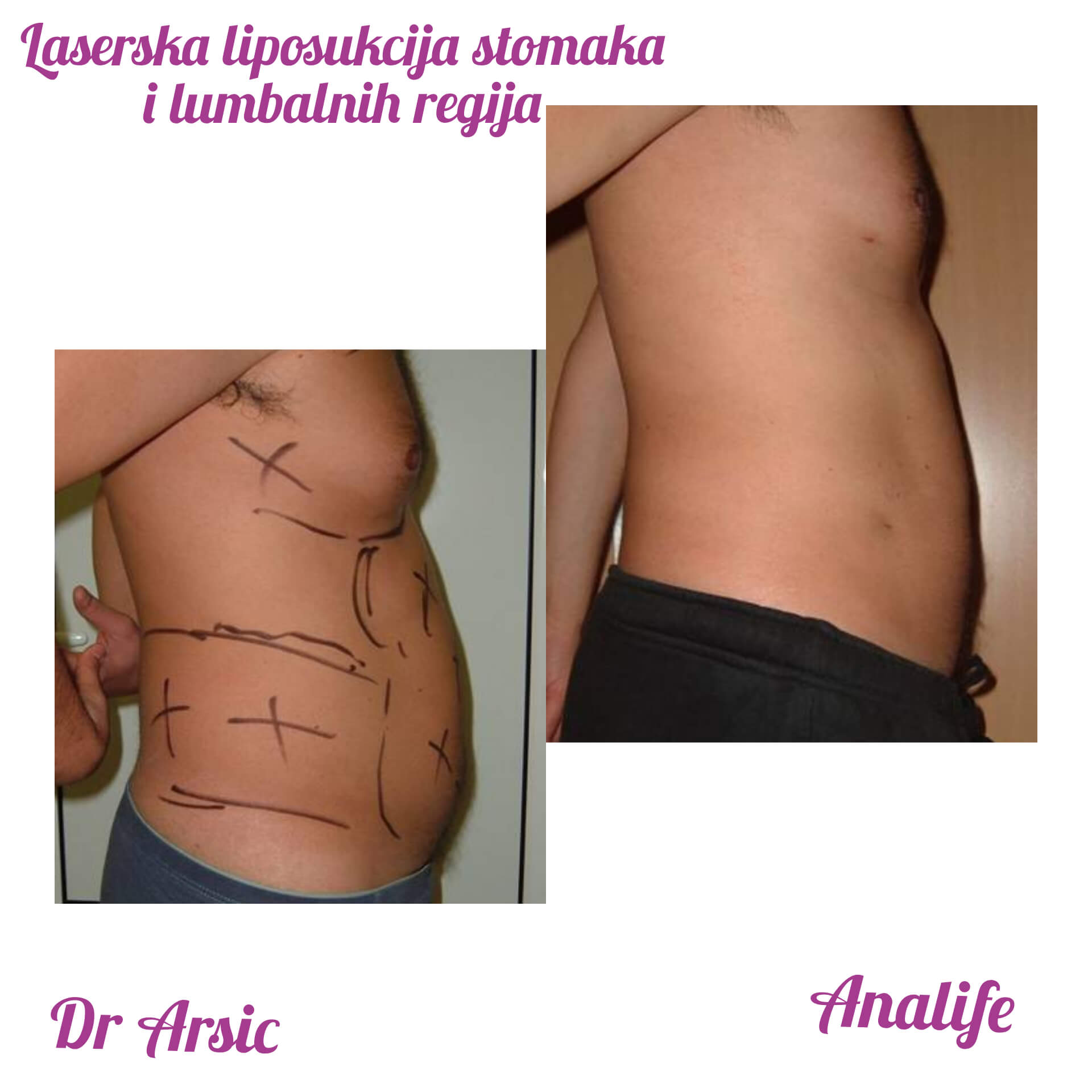 Laserska liposukcija stomaka, struka i leđa – oblikovanje linije tela - slika 12