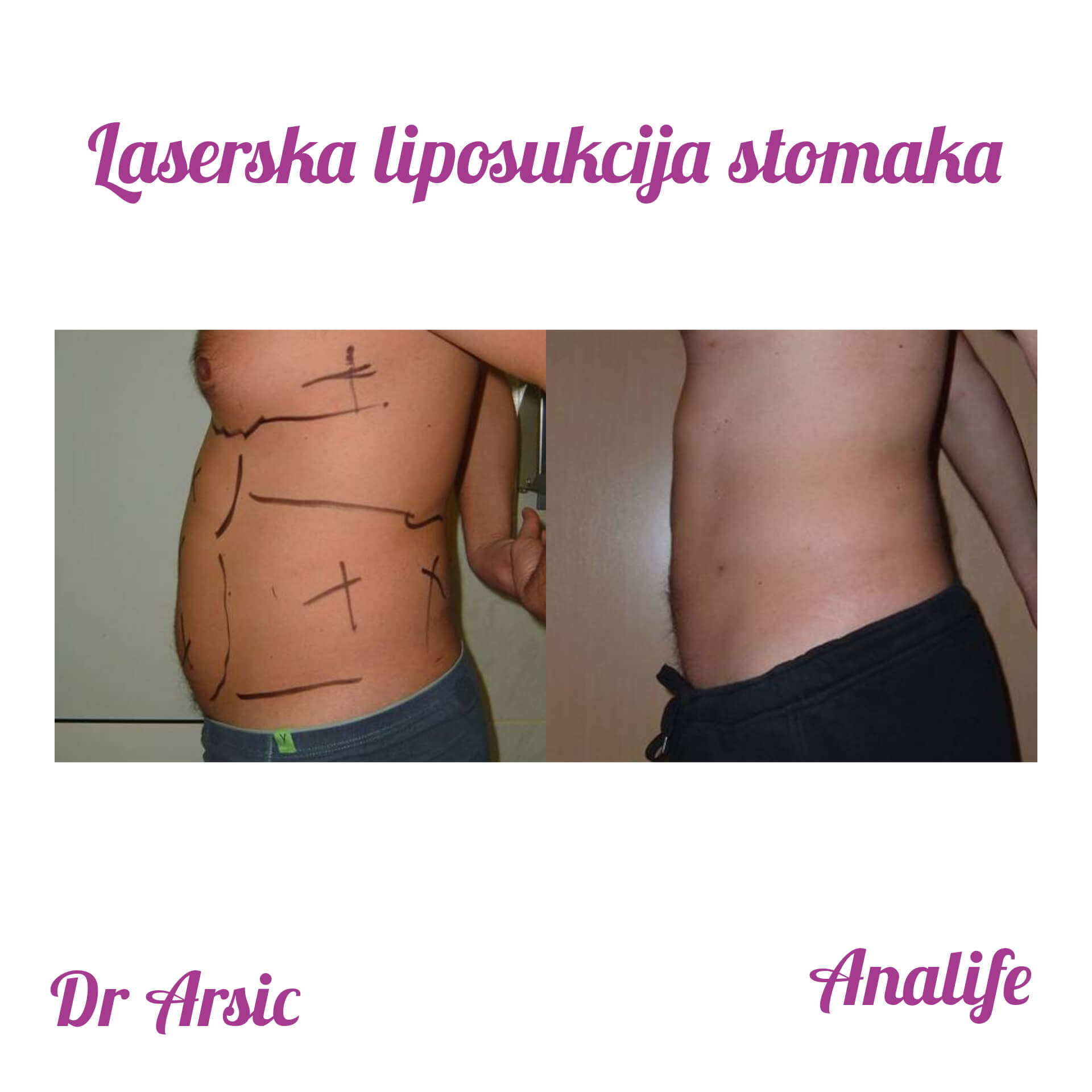 Laserska liposukcija stomaka, struka i leđa – oblikovanje linije tela - slika 13