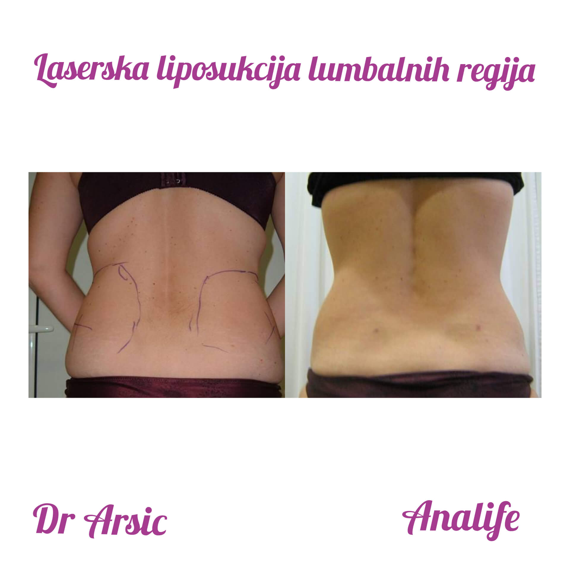 Laserska liposukcija stomaka, struka i leđa – oblikovanje linije tela - slika 14