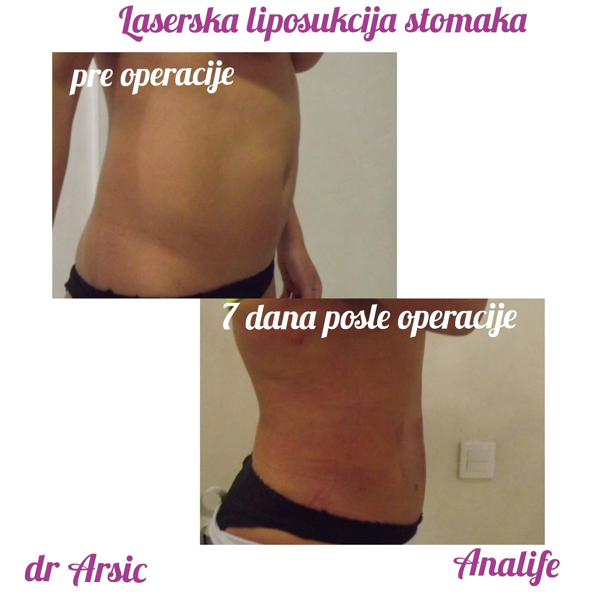 Laserska liposukcija stomaka, struka i leđa – oblikovanje linije tela - slika 16