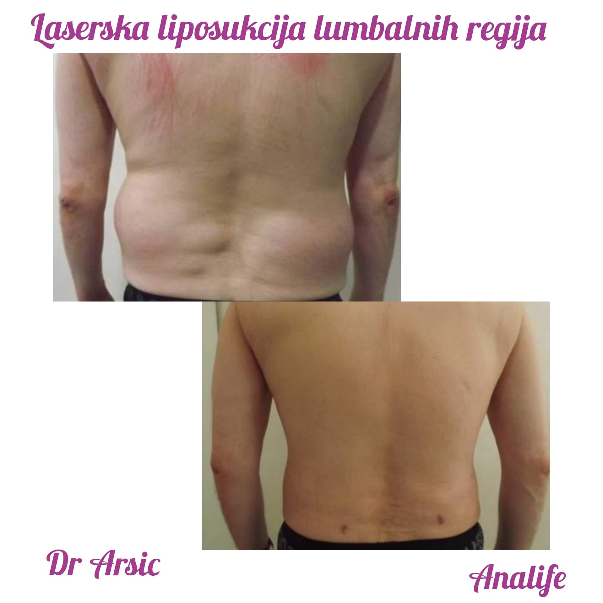 Laserska liposukcija stomaka, struka i leđa – oblikovanje linije tela - slika 17