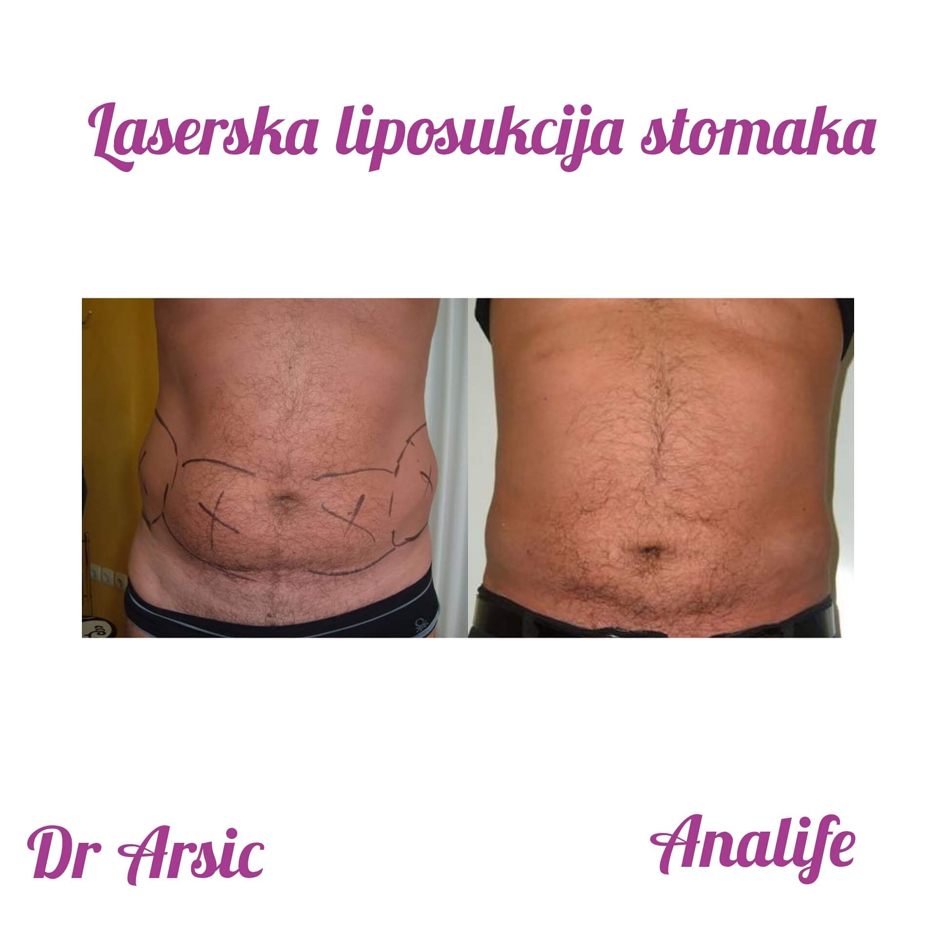 Laserska liposukcija stomaka, struka i leđa – oblikovanje linije tela - slika 18
