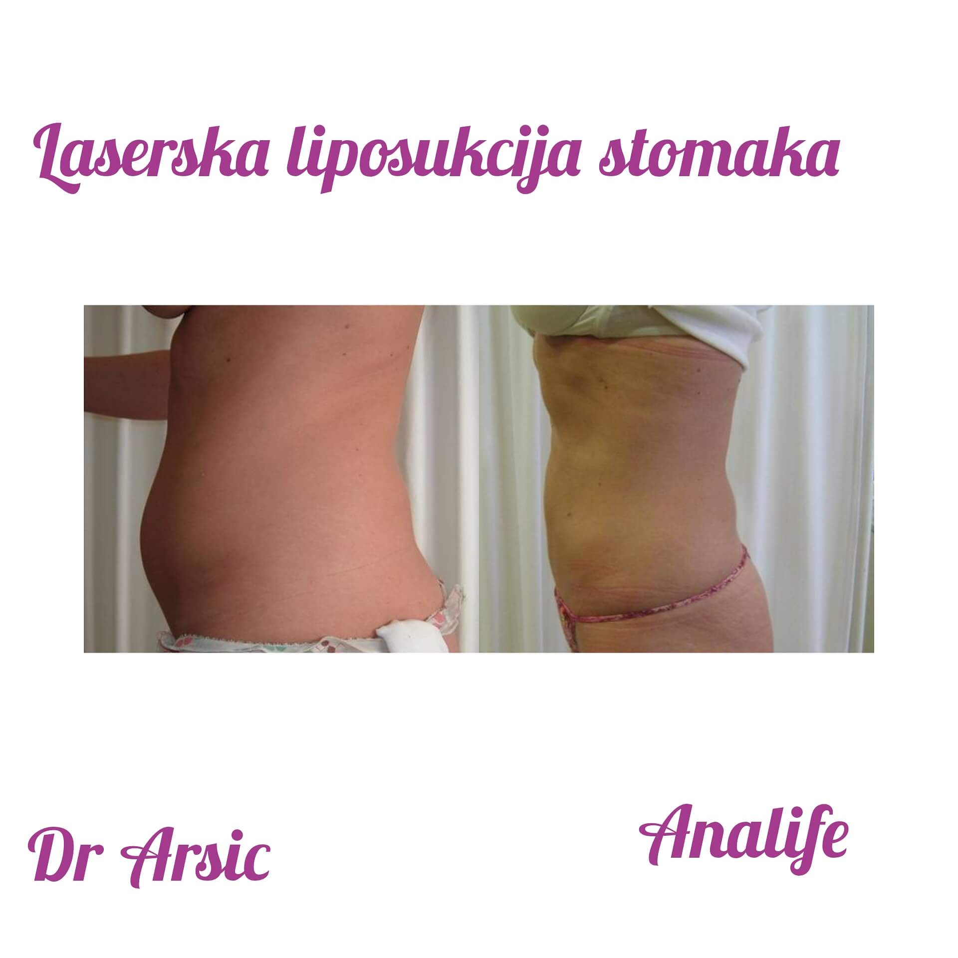 Laserska liposukcija stomaka, struka i leđa – oblikovanje linije tela - slika 19