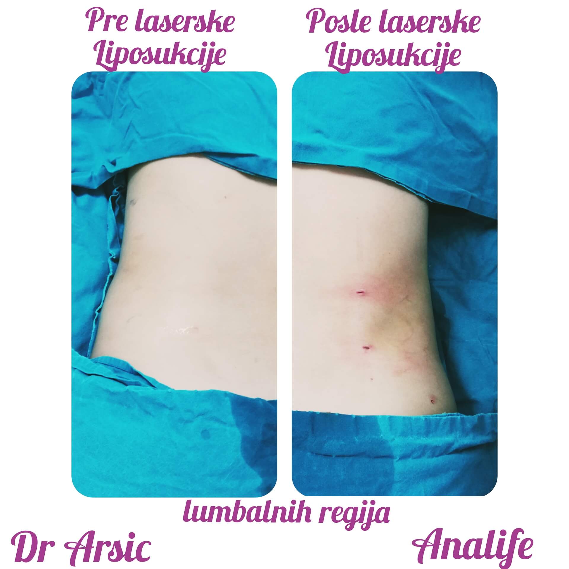 Laserska liposukcija stomaka, struka i leđa – oblikovanje linije tela - slika 20