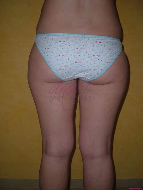 Laserska liposukcija nogu – oblikovanje butina, kolena i konture nogu - slika 1