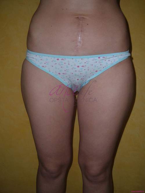 Laserska liposukcija nogu – oblikovanje butina, kolena i konture nogu - slika 2