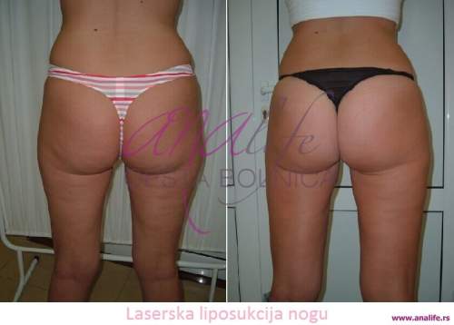 Laserska liposukcija nogu – oblikovanje butina, kolena i konture nogu - slika 3