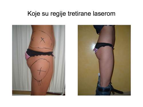 Laserska liposukcija nogu – oblikovanje butina, kolena i konture nogu - slika 5