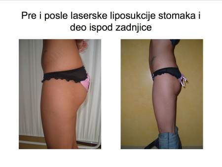 Laserska liposukcija nogu – oblikovanje butina, kolena i konture nogu - slika 6
