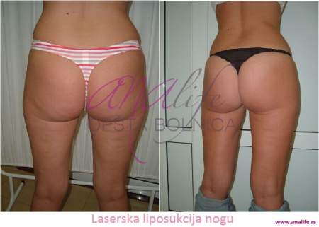 Laserska liposukcija nogu – oblikovanje butina, kolena i konture nogu - slika 7