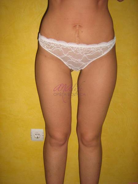 Laserska liposukcija nogu – oblikovanje butina, kolena i konture nogu - slika 8