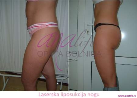 Laserska liposukcija nogu – oblikovanje butina, kolena i konture nogu - slika 9