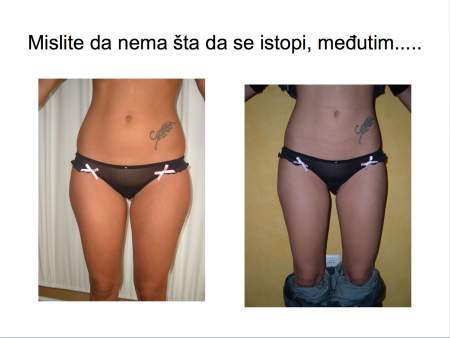 Laserska liposukcija nogu – oblikovanje butina, kolena i konture nogu - slika 10