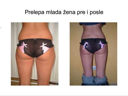 Laserska liposukcija nogu – oblikovanje butina, kolena i konture nogu - slika 11
