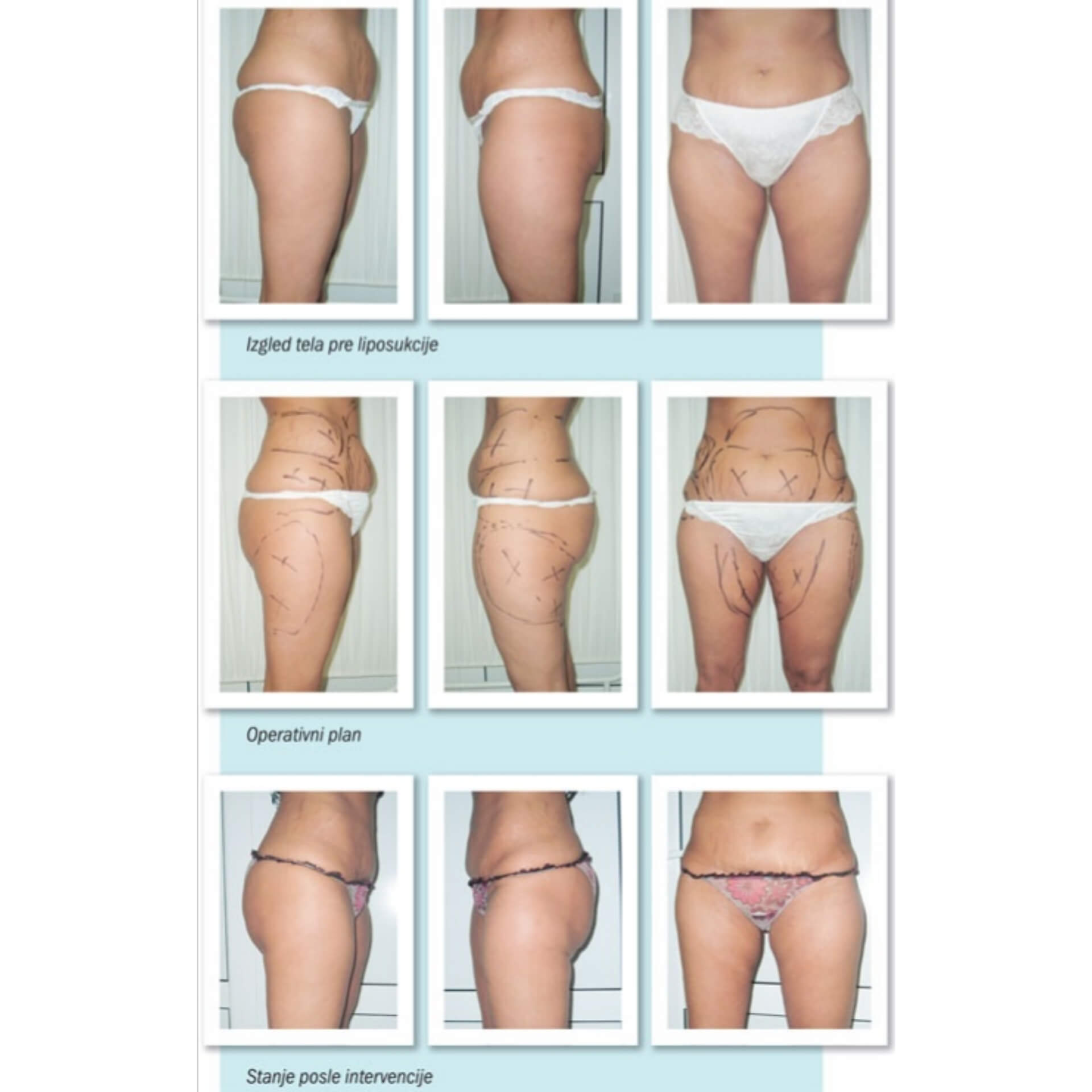 Laserska liposukcija nogu – oblikovanje butina, kolena i konture nogu - slika 13