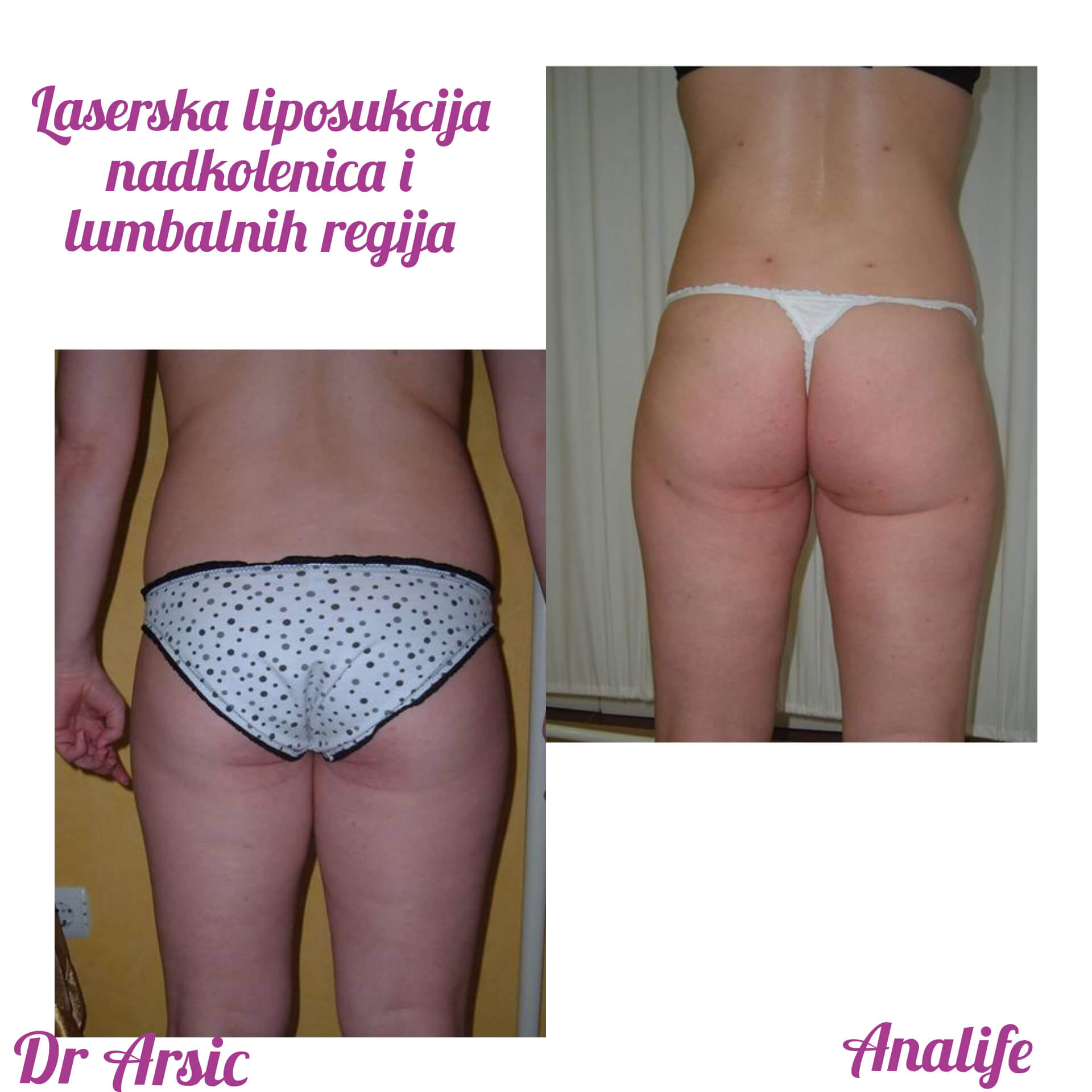 Laserska liposukcija nogu – oblikovanje butina, kolena i konture nogu - slika 14