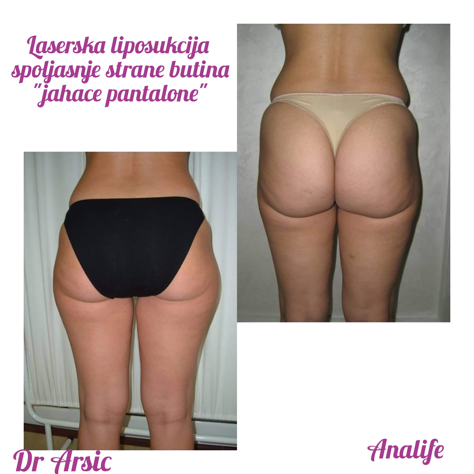 Laserska liposukcija nogu – oblikovanje butina, kolena i konture nogu - slika 15