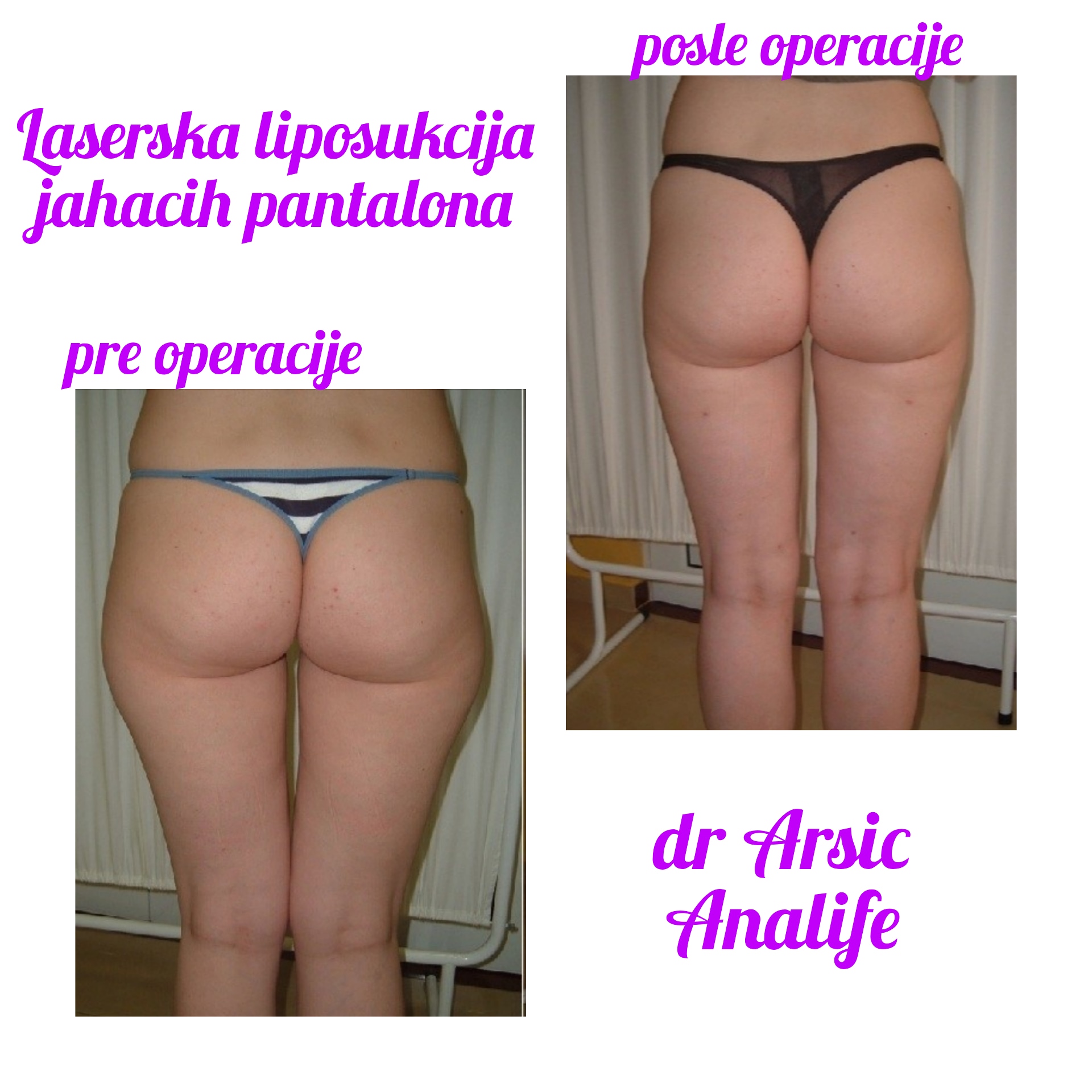 Laserska liposukcija nogu – oblikovanje butina, kolena i konture nogu - slika 16