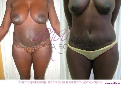 Dermolipektomija/abdominoplastika– ravan stomak, uklanjanje viška kože i oblikovanje trbuha - slika 1