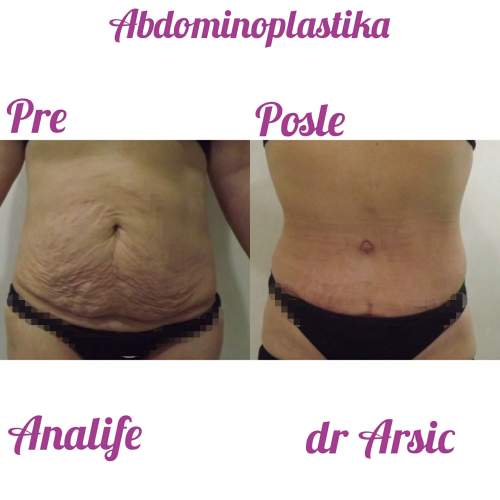 Dermolipektomija/abdominoplastika– ravan stomak, uklanjanje viška kože i oblikovanje trbuha - slika 2