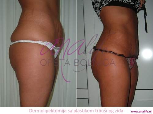 Dermolipektomija/abdominoplastika– ravan stomak, uklanjanje viška kože i oblikovanje trbuha - slika 3