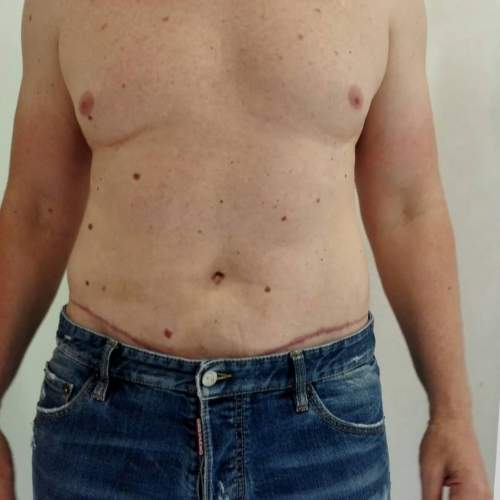 Dermolipektomija/abdominoplastika– ravan stomak, uklanjanje viška kože i oblikovanje trbuha - slika 4