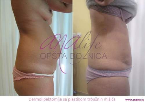 Dermolipektomija/abdominoplastika– ravan stomak, uklanjanje viška kože i oblikovanje trbuha - slika 5