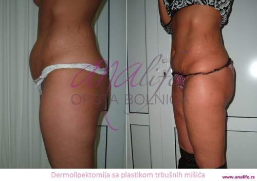 Dermolipektomija/abdominoplastika– ravan stomak, uklanjanje viška kože i oblikovanje trbuha - slika 6