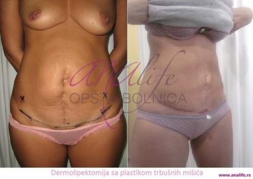 Dermolipektomija/abdominoplastika– ravan stomak, uklanjanje viška kože i oblikovanje trbuha - slika 8