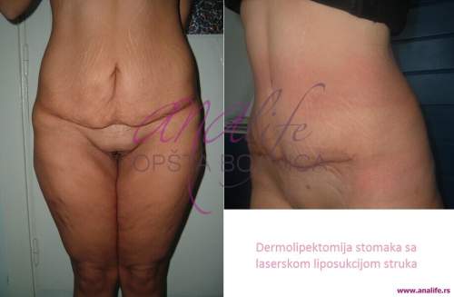 Dermolipektomija/abdominoplastika– ravan stomak, uklanjanje viška kože i oblikovanje trbuha - slika 9