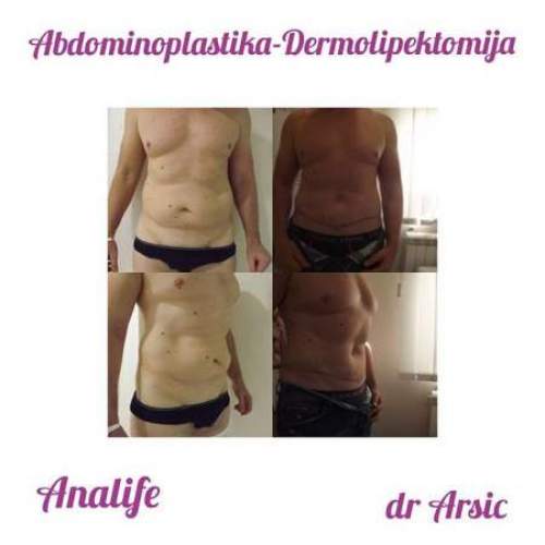 Dermolipektomija/abdominoplastika– ravan stomak, uklanjanje viška kože i oblikovanje trbuha - slika 10