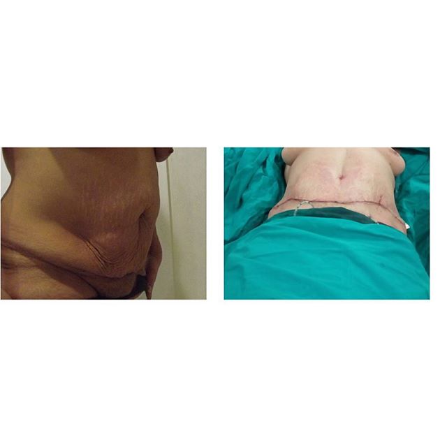 Dermolipektomija/abdominoplastika– ravan stomak, uklanjanje viška kože i oblikovanje trbuha - slika 11