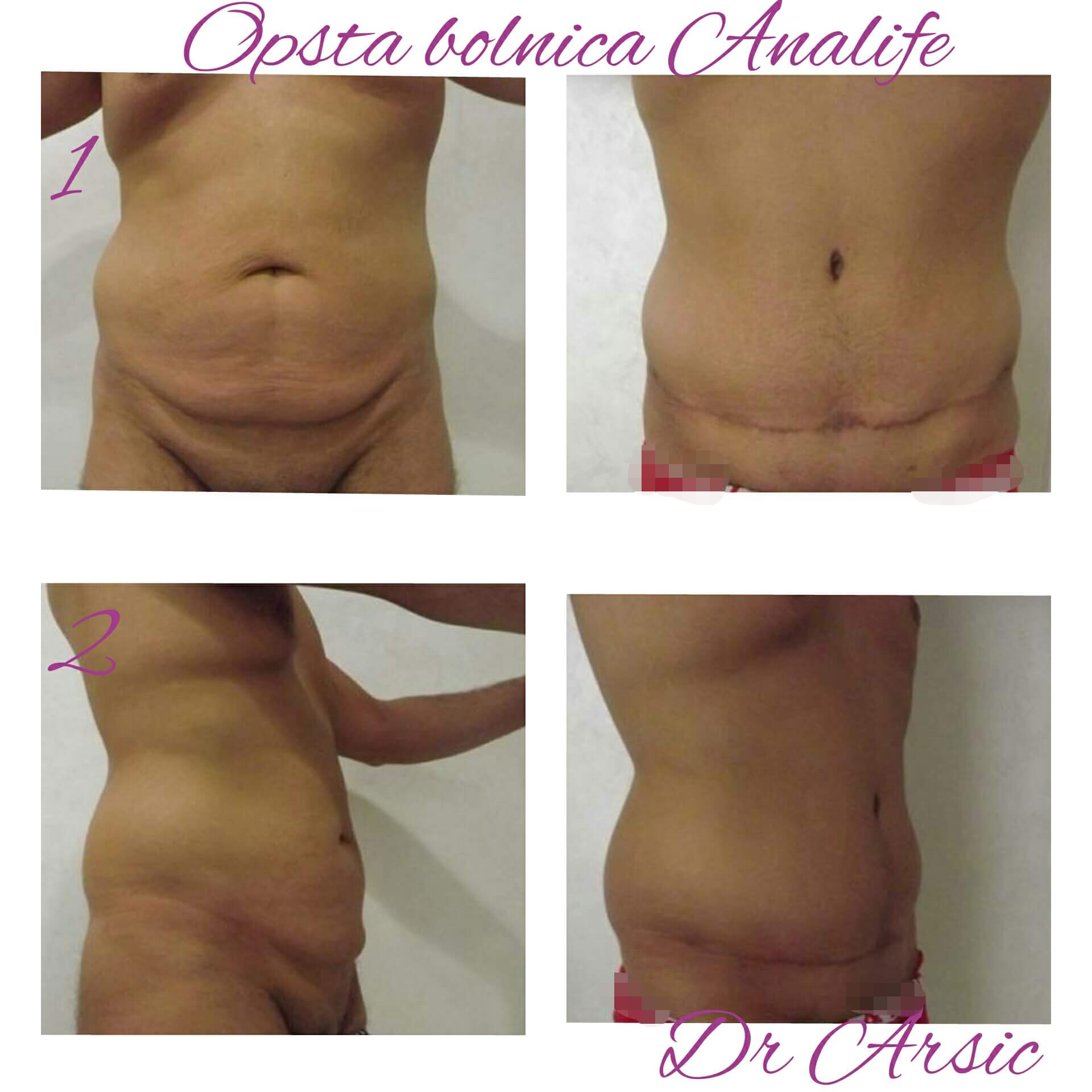 Dermolipektomija/abdominoplastika– ravan stomak, uklanjanje viška kože i oblikovanje trbuha - slika 14