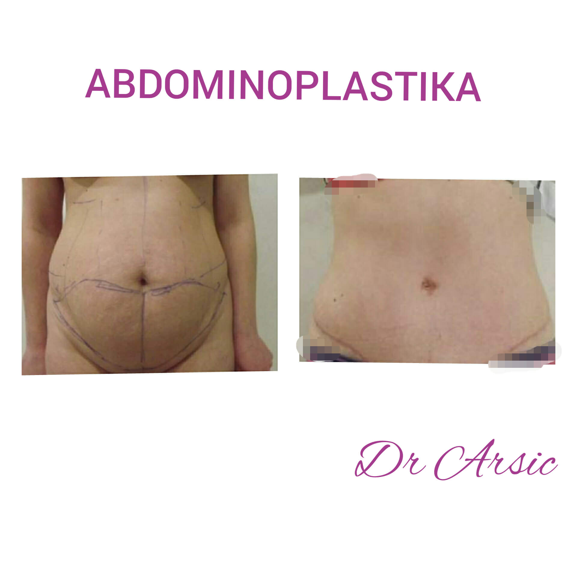 Dermolipektomija/abdominoplastika– ravan stomak, uklanjanje viška kože i oblikovanje trbuha - slika 16