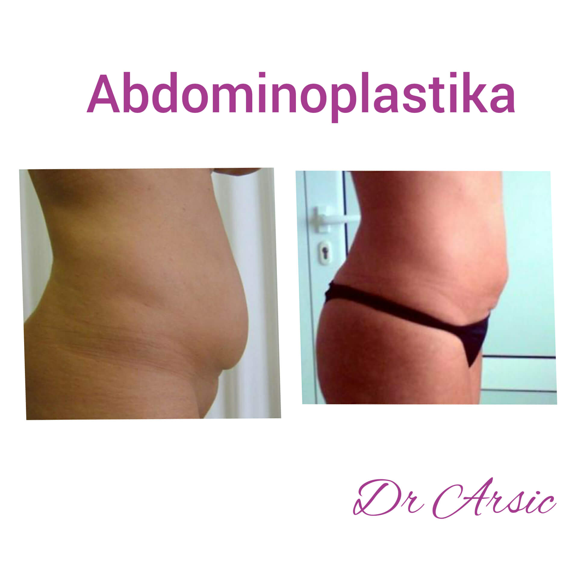 Dermolipektomija/abdominoplastika– ravan stomak, uklanjanje viška kože i oblikovanje trbuha - slika 17