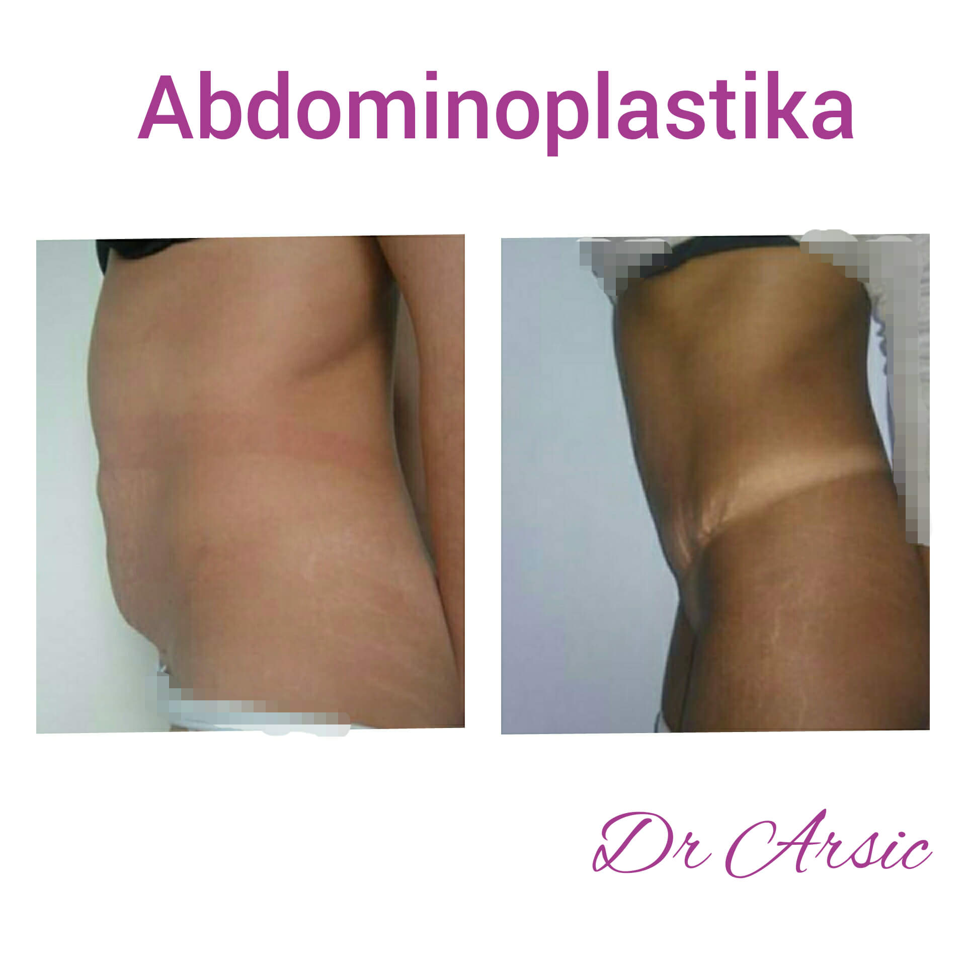 Dermolipektomija/abdominoplastika– ravan stomak, uklanjanje viška kože i oblikovanje trbuha - slika 18