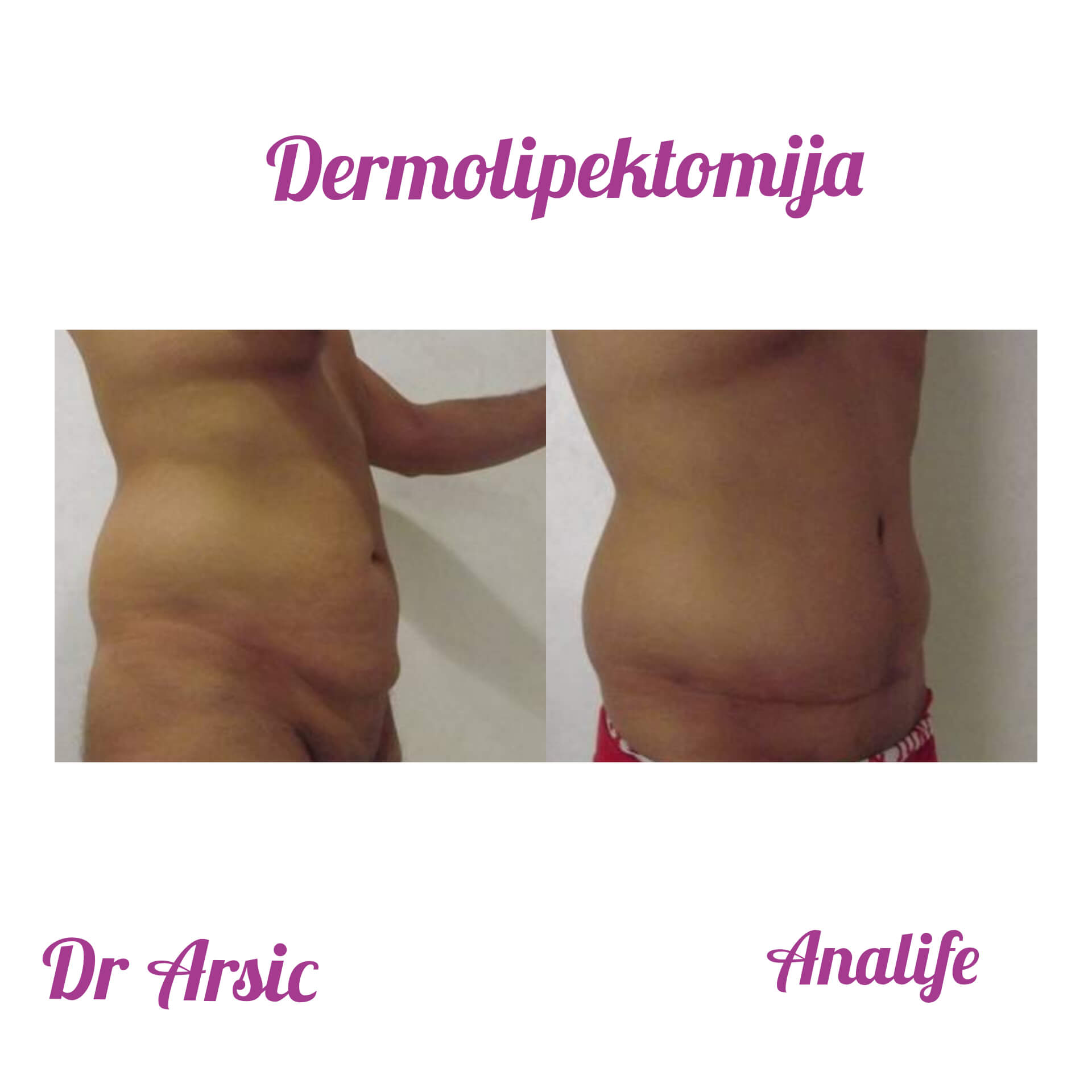 Dermolipektomija/abdominoplastika– ravan stomak, uklanjanje viška kože i oblikovanje trbuha - slika 20