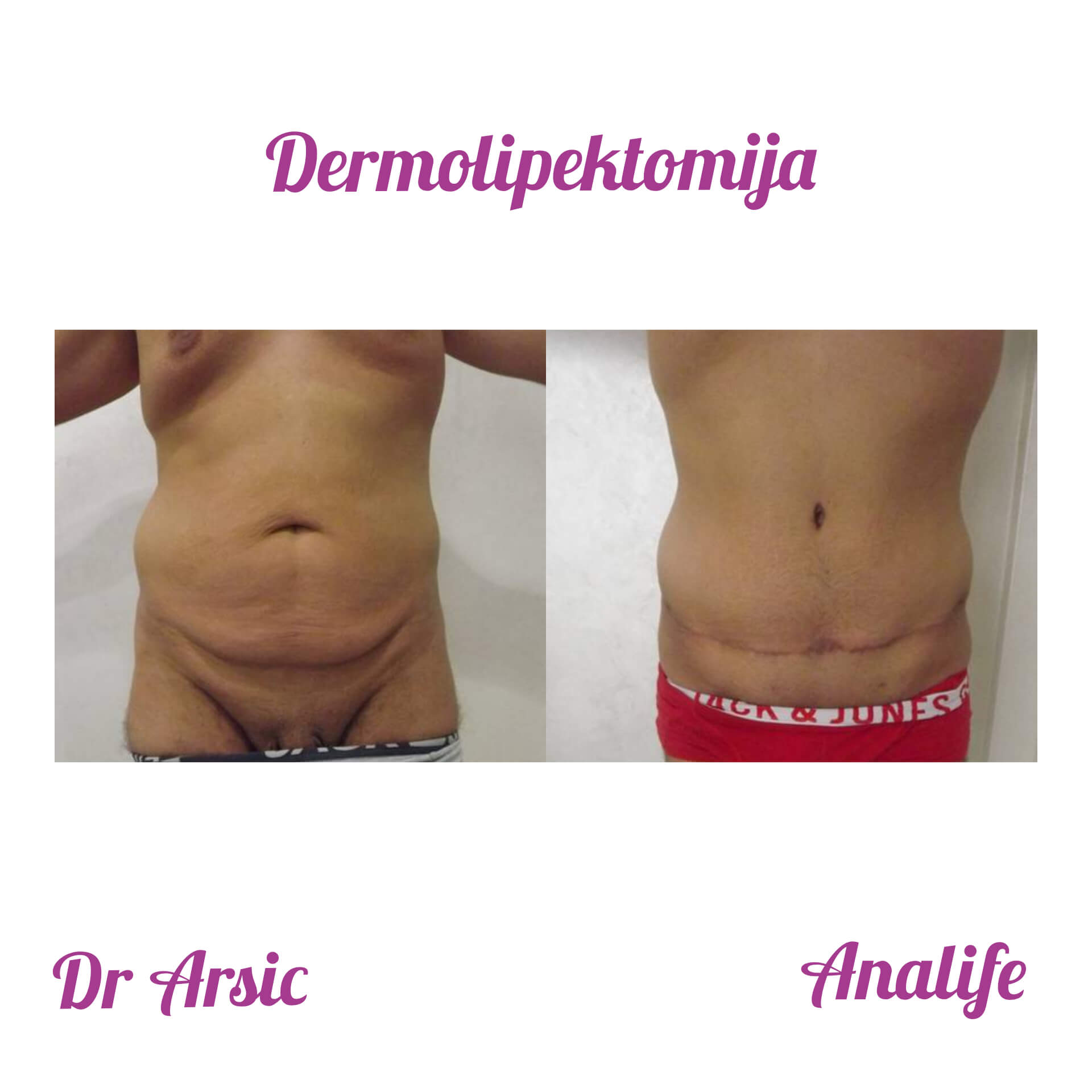 Dermolipektomija/abdominoplastika– ravan stomak, uklanjanje viška kože i oblikovanje trbuha - slika 21