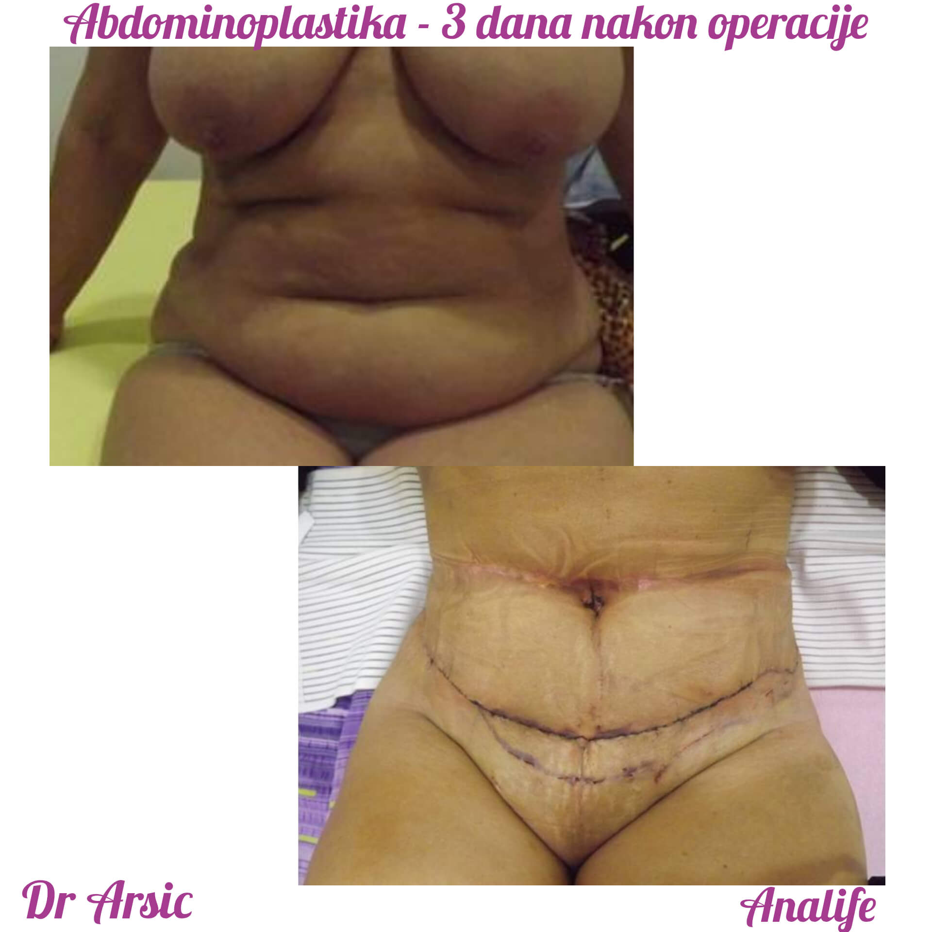 Dermolipektomija/abdominoplastika– ravan stomak, uklanjanje viška kože i oblikovanje trbuha - slika 22
