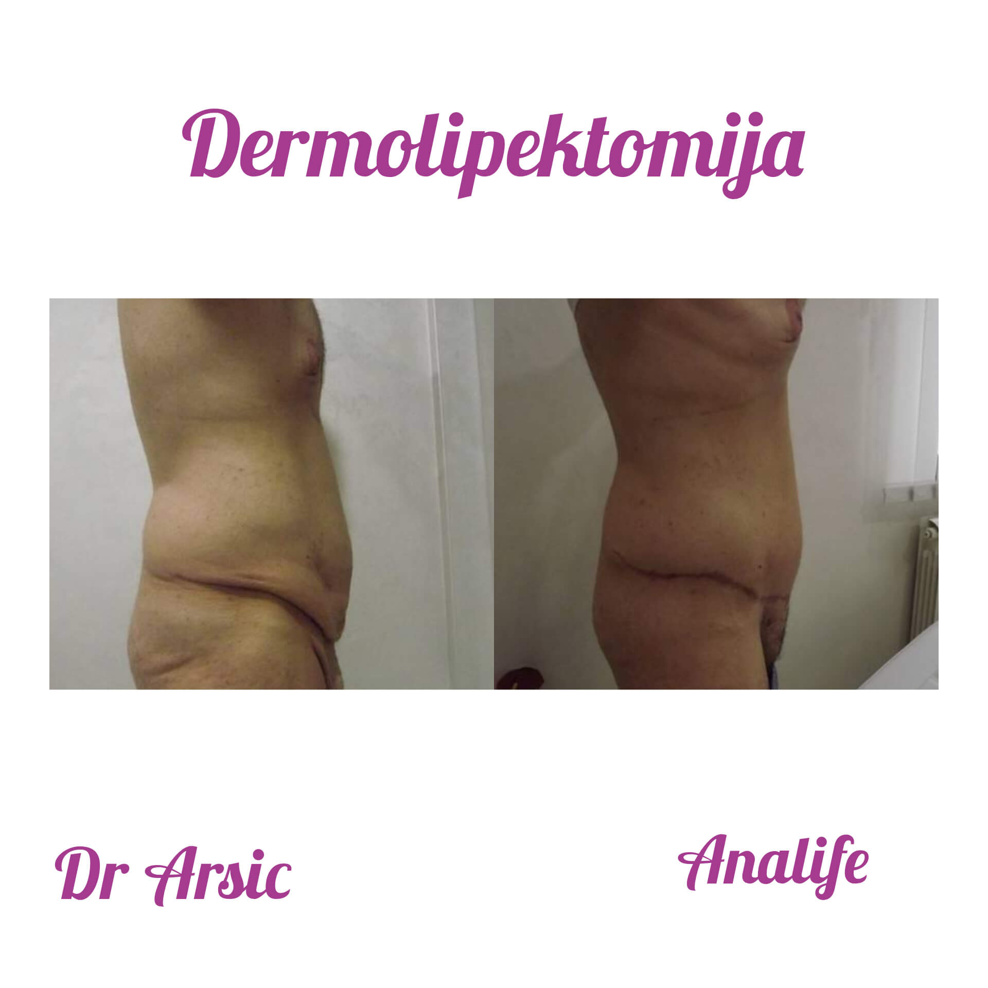 Dermolipektomija/abdominoplastika– ravan stomak, uklanjanje viška kože i oblikovanje trbuha - slika 23