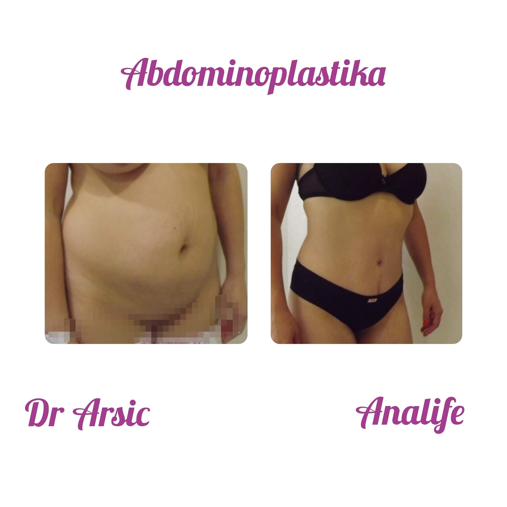 Dermolipektomija/abdominoplastika– ravan stomak, uklanjanje viška kože i oblikovanje trbuha - slika 25