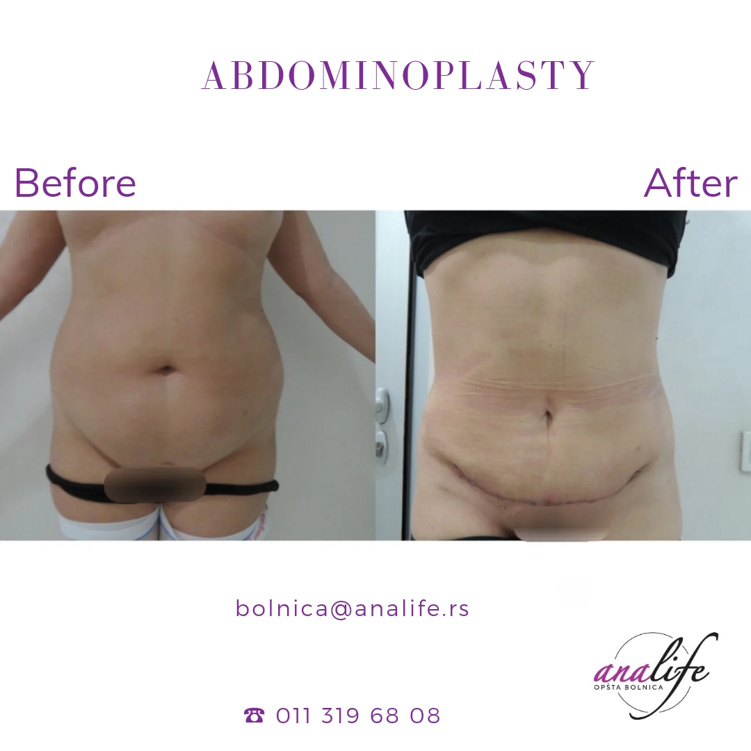 Dermolipektomija/abdominoplastika– ravan stomak, uklanjanje viška kože i oblikovanje trbuha - slika 26