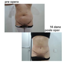 Dermolipektomija/abdominoplastika– ravan stomak, uklanjanje viška kože i oblikovanje trbuha - slika 27