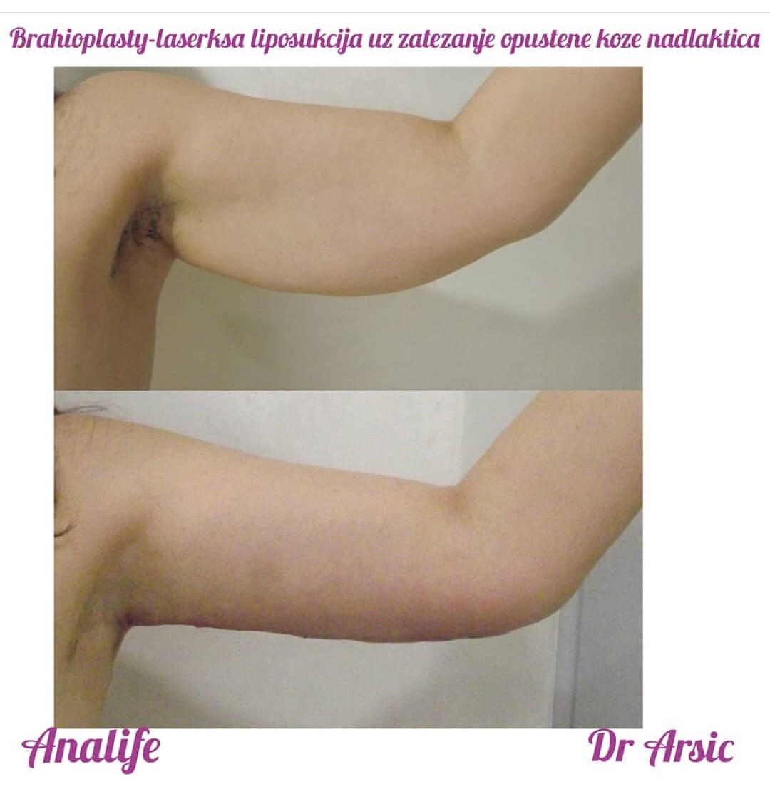 Brahioplastika (zatezanje nadlaktica) – uklanjanje viška kože i oblikovanje ruku - slika 1