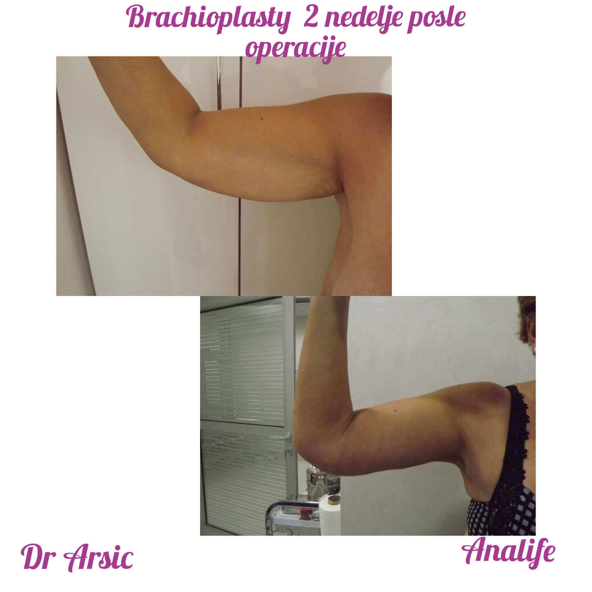 Brahioplastika (zatezanje nadlaktica) – uklanjanje viška kože i oblikovanje ruku - slika 2
