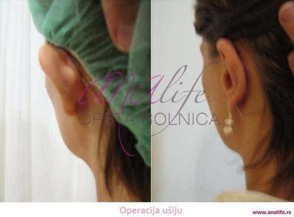 Operacija ušiju (otoplastika) – korekcija klempavih ušiju i prirodan oblik ušne školjke - slika 3